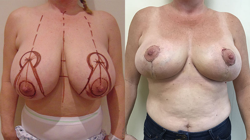 breast reduction before & after