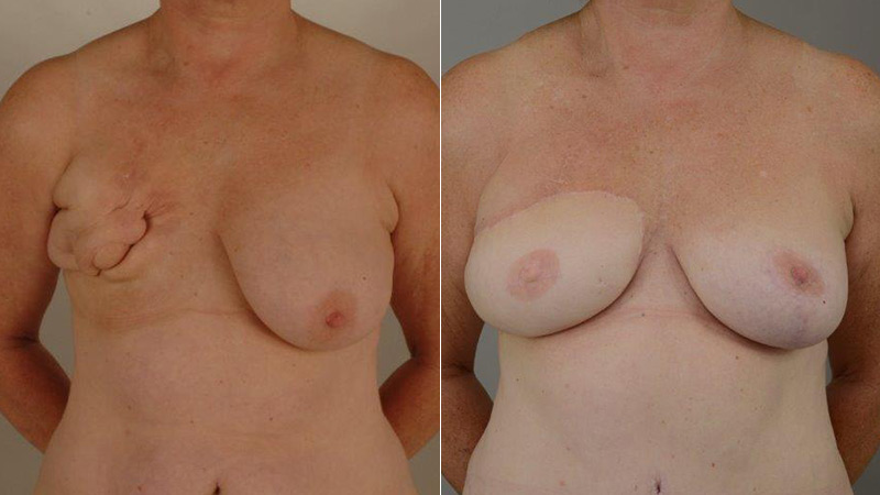 DIep reconstruction before & after