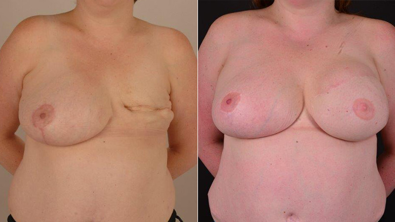 breast reconstruction with Diep flap before & after