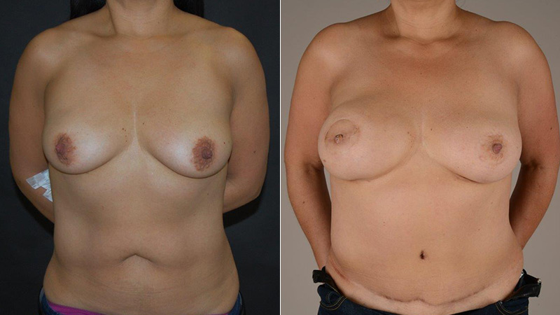 breast reconstruction with Diep flap before & after