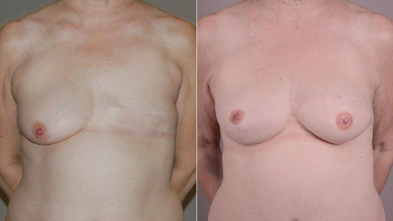 breast reconstruction with Diep flap before & after