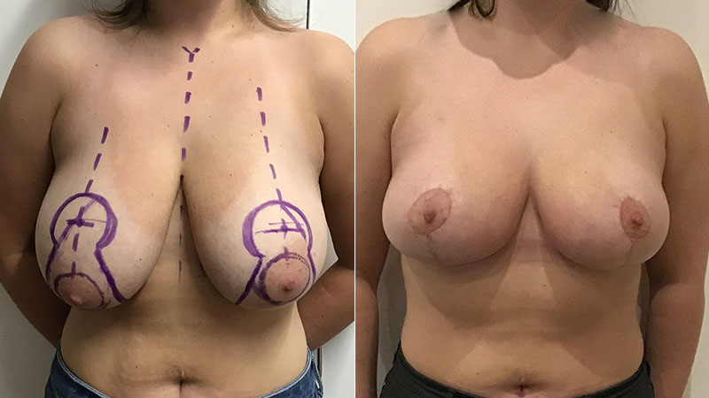breast reduction before & after