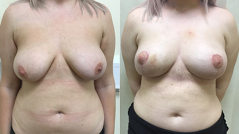 breast uplift before & after
