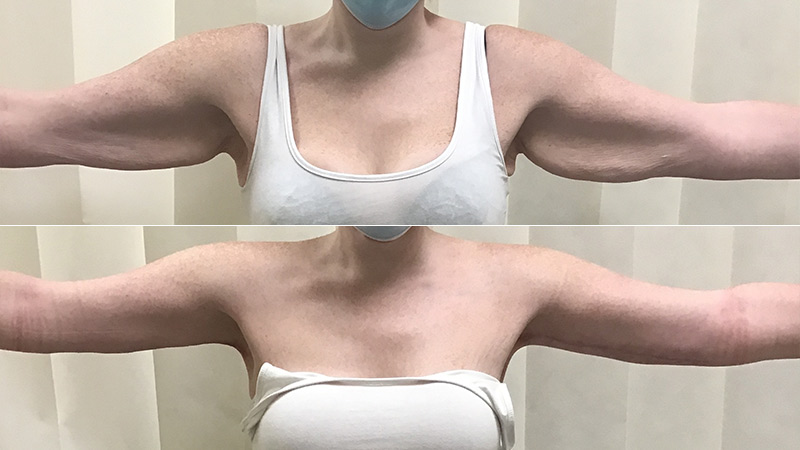 armlift