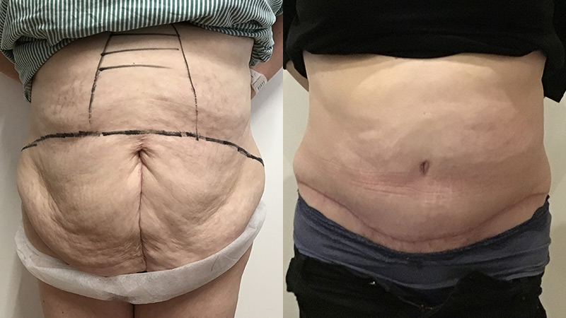 abdominoplasty before & after