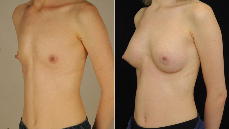 breast augmentation before & after