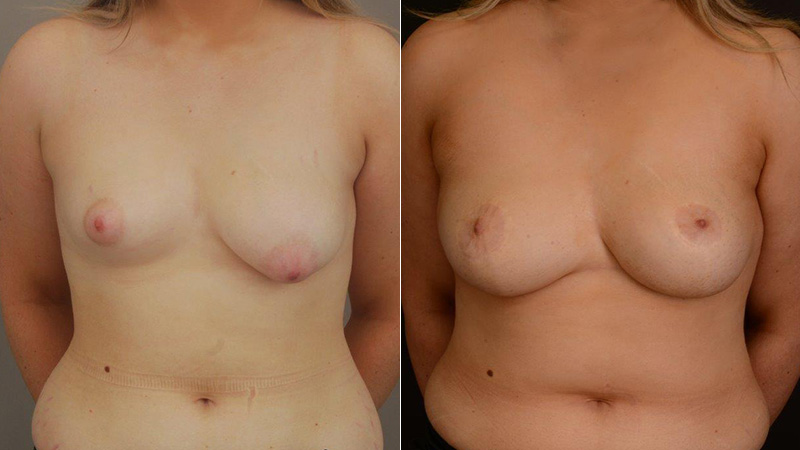 before and after tuberous breast correction