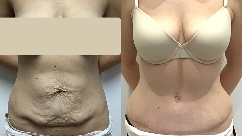 abdominoplasty before & after