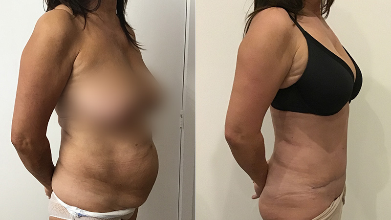 abdominoplasty before & after