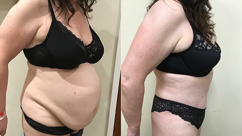 abdominoplasty before & after