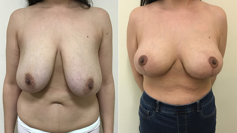breast uplift before & after