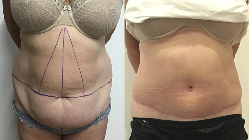 abdominoplasty before & after