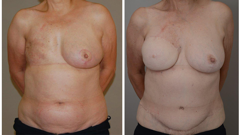 breast reconstruction with Diep flap before & after