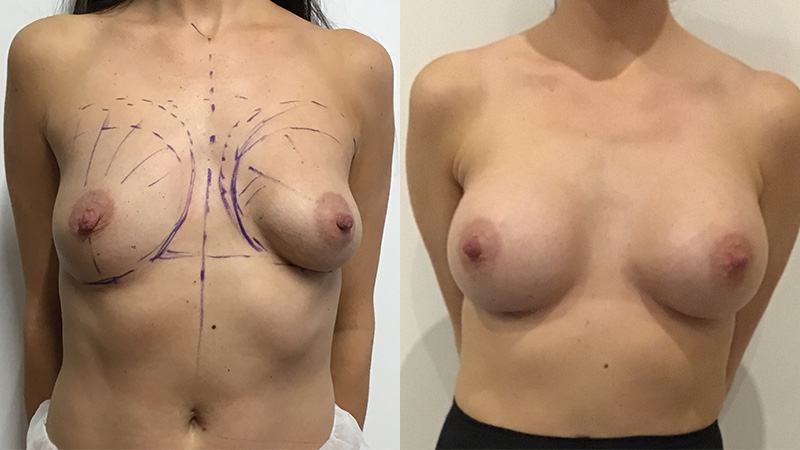 bilateral revision augmentation and lipomodelling
