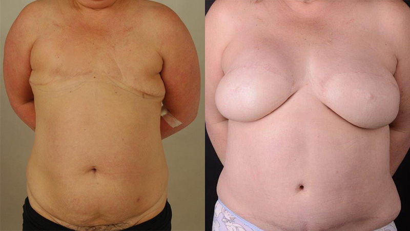 Bilateral delayed DIEP reconstruction