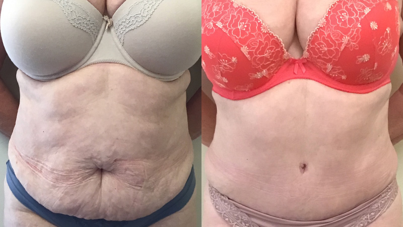 abdominoplasty before & after