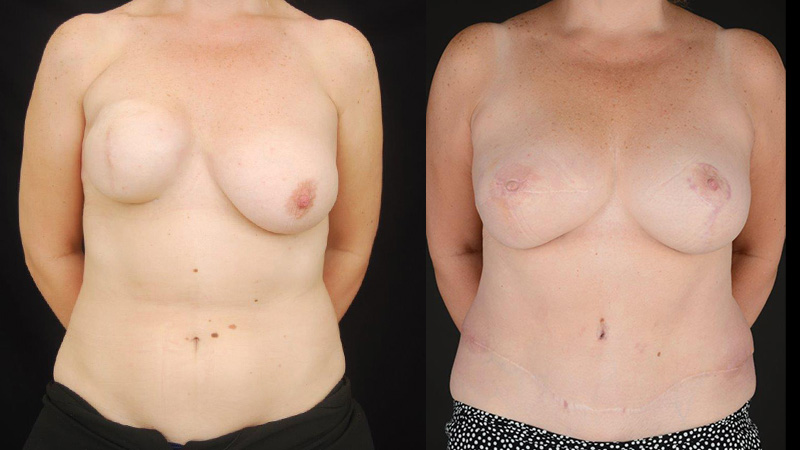 Right mastectomy DIEP flap and left uplift