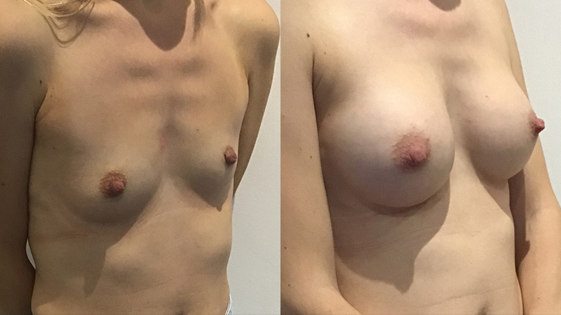 breast augmentation before & after