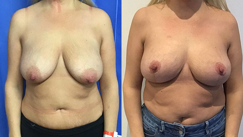breast uplift before & after