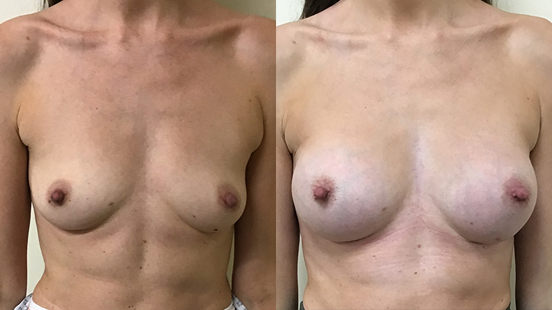 breast augmentation and lipomodelling