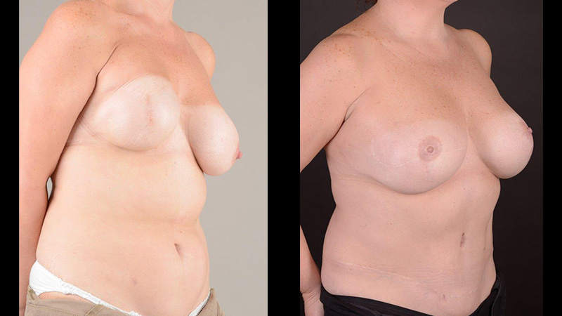 Implant exchange DIEP flap and left uplift