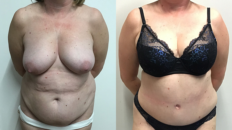 abdominoplasty before & after