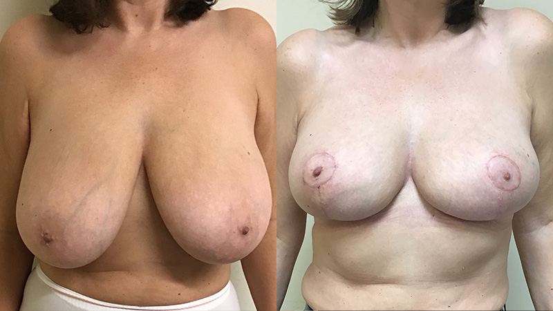 breast reduction before & after