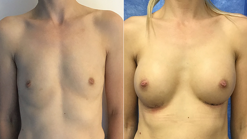 breast augmentation before & after