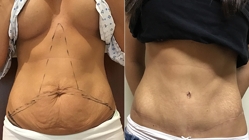 abdominoplasty before & after