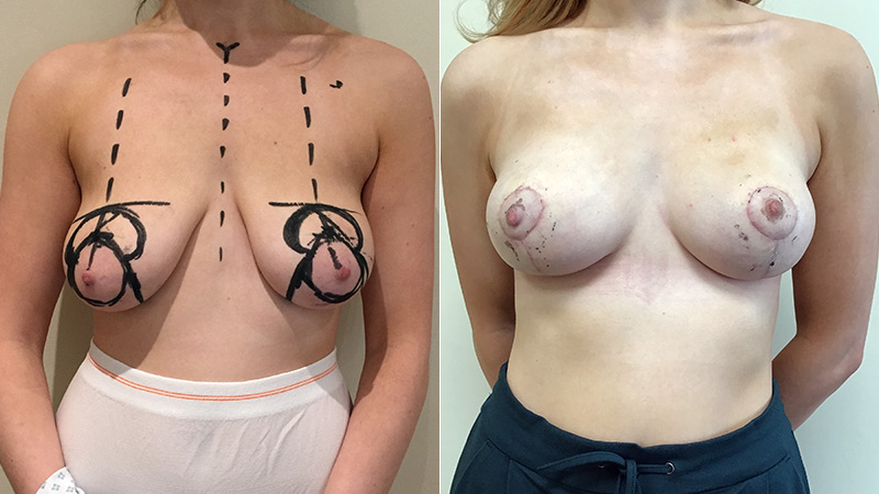 before and after breast uplift